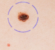A melanoma vagy bőrrák jelei és fajtái
