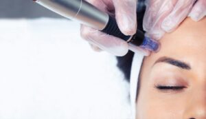 Mezoterápia Debrecen központjában, az Apollon Beauty-ban